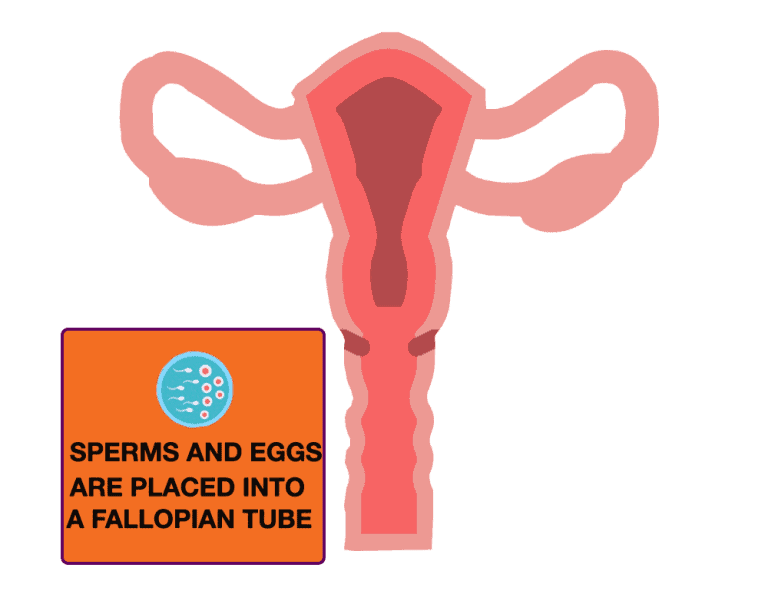GIFT: Sperms and eggs are placed into a fallopian tube