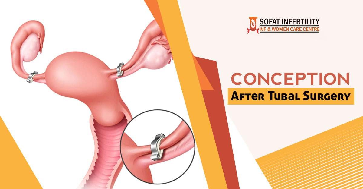 Everything you need to know and understand about Conception after Tubal Surgery?