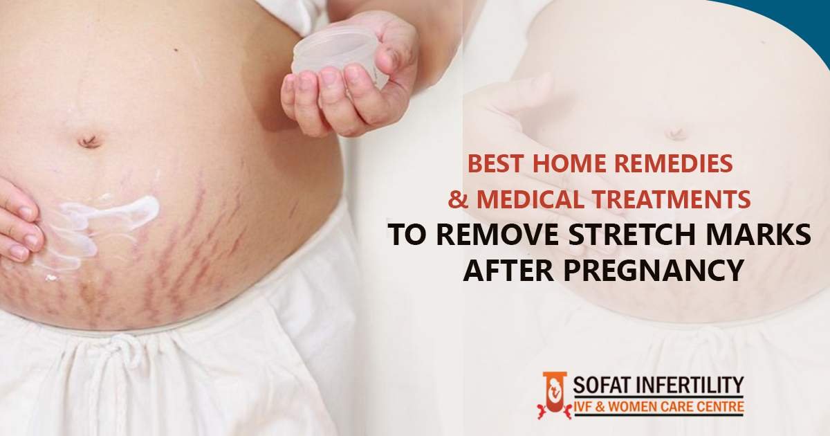 Removal of Stretch Marks After Pregnancy: Remedies & Medical Treatments