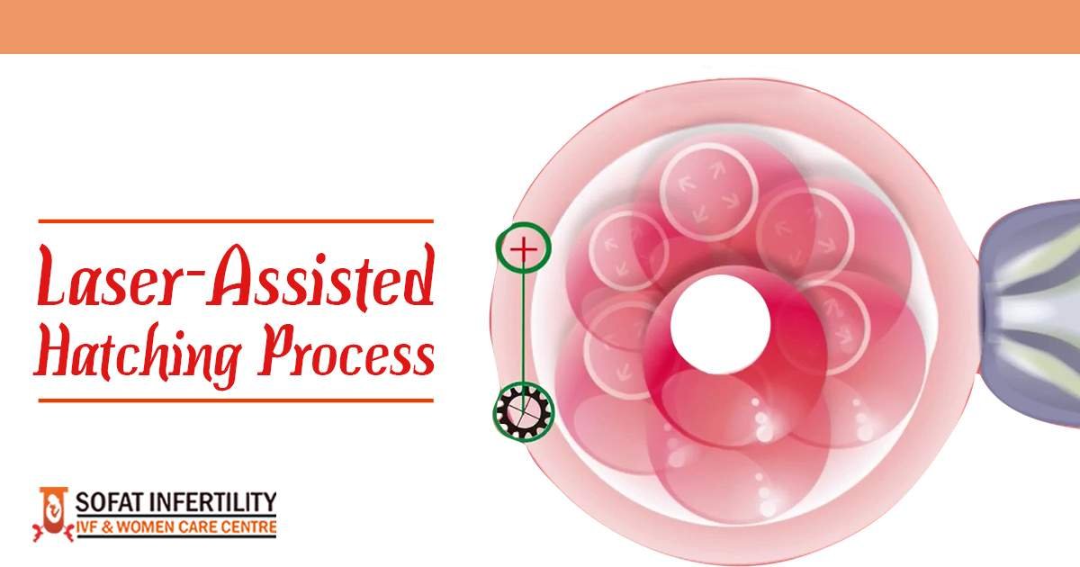 Why Laser Assisted Hatching is Best?