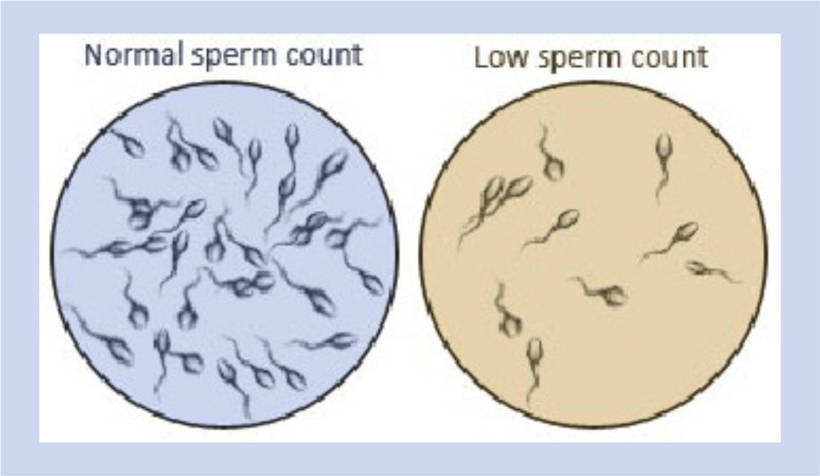 Oligospermia Causes, Symptoms And Treatment
