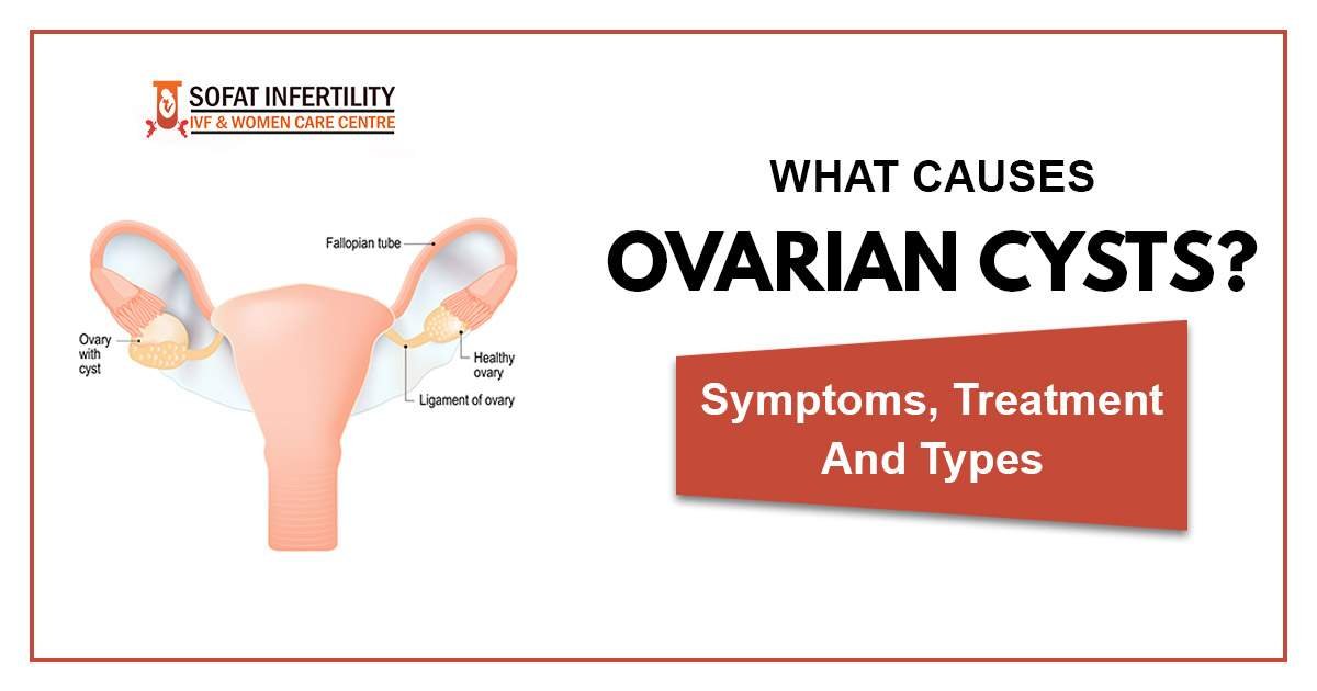 What is Ovarian Cyst? Causes, Symptoms, Treatment, Types