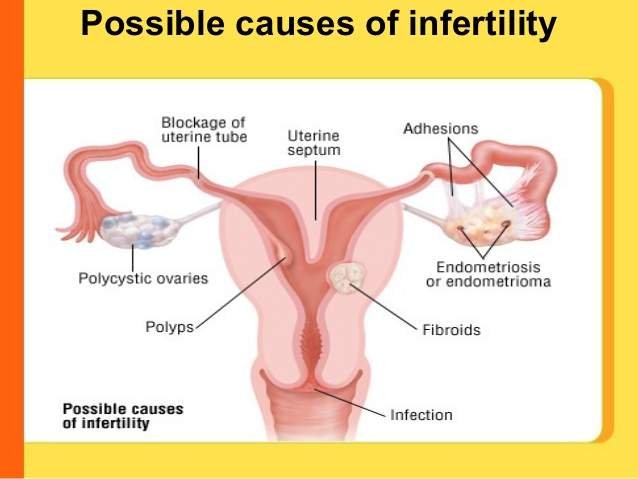 Possible Causes of Infertility Problems in Women Today