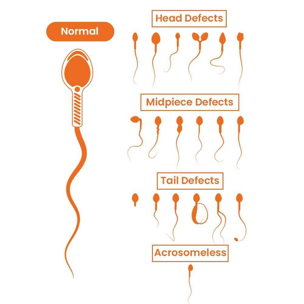 Sperm Morphology Defects - Head, Midpiece, Tail Defects and Acrosomeless